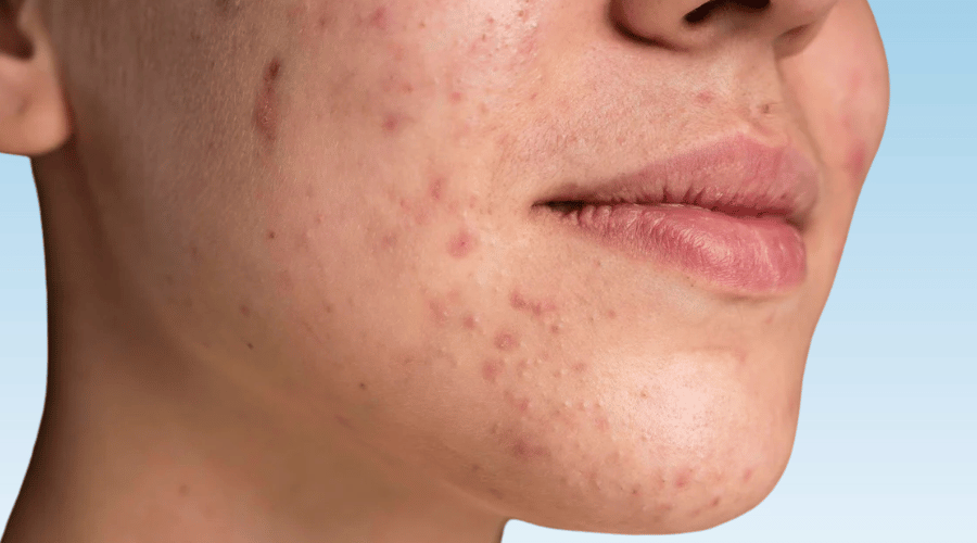 How to deal with: hormonale acne - Daily Beauty - Your skincare sidekick