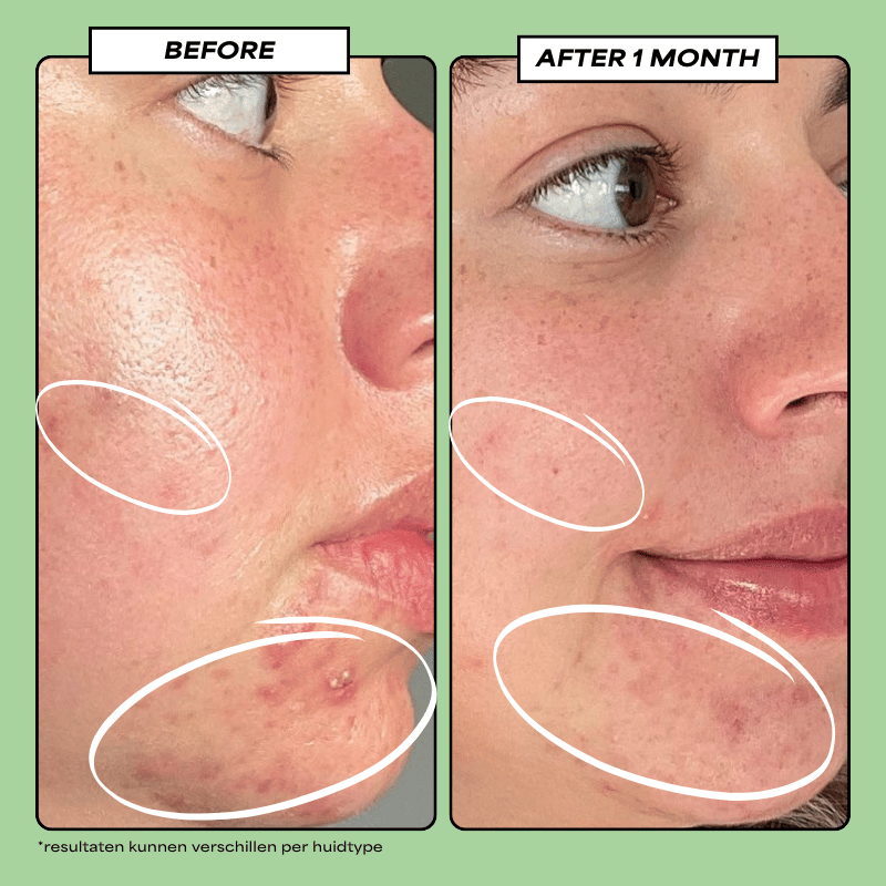 Translation missing: nl.Clear Acne Serum 30 ML - Daily Beauty - Your skincare sidekick