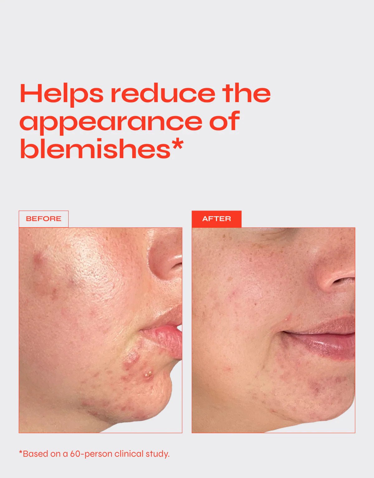 Translation missing: nl.Clear Acne Serum 30 ML - Daily Beauty - Your skincare sidekick